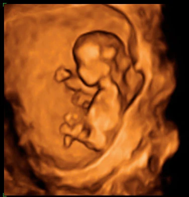 Imagen sobre "Ecografía Genética + Doppler"