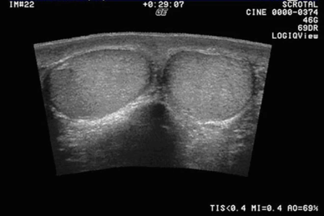 Imagen sobre "Ecografía Testicular"