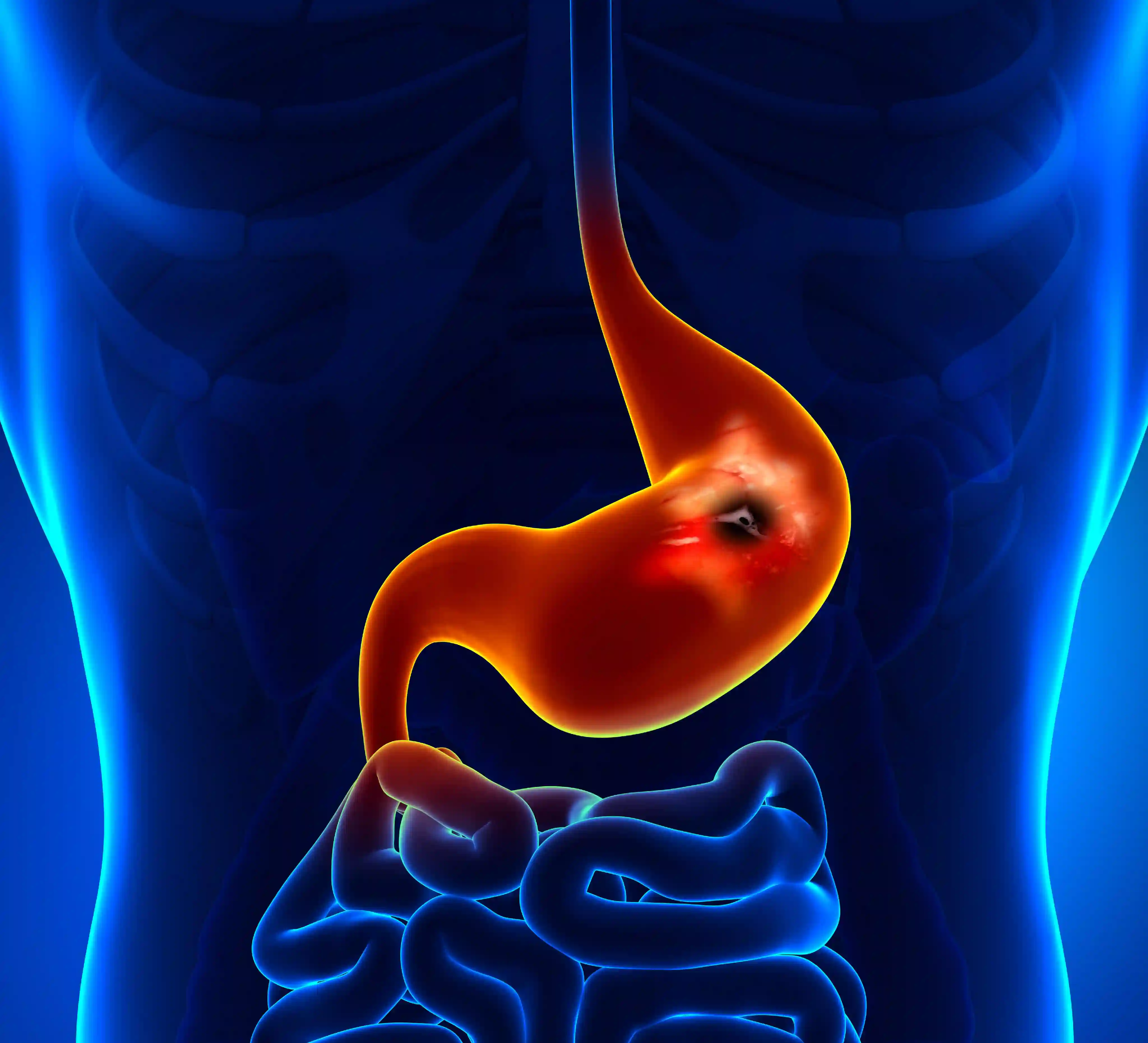 Imagen sobre "Gastritis y Úlceras Gástricas"