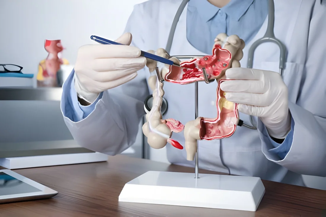 Gastroenterólogo mostrando y señalando una maqueta del intestino grueso