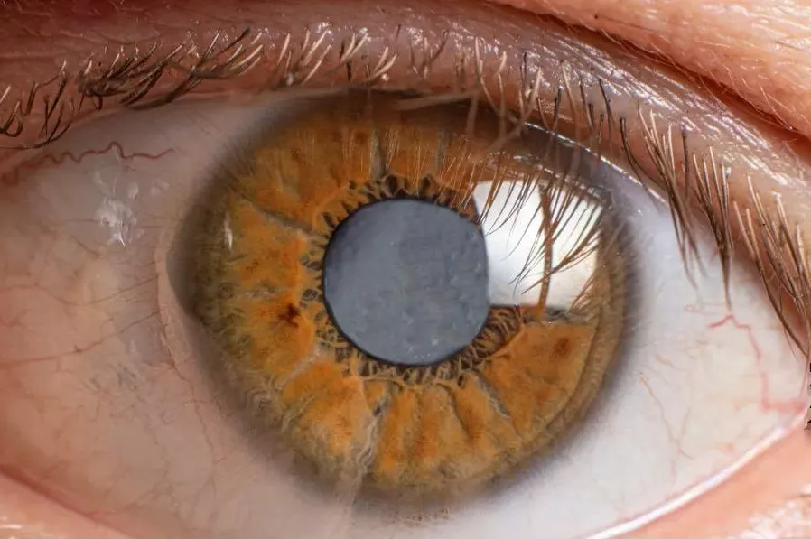 Imagen sobre "Examen de Fondo de Ojo"