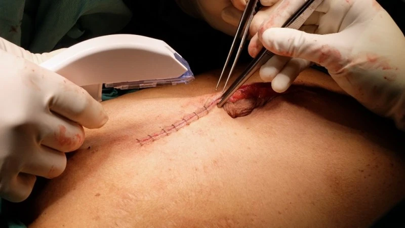 Imagen sobre "Sutura de Heridas"